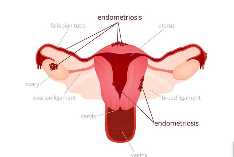 What is Endometriosis? Learn The Causes & Symptoms
